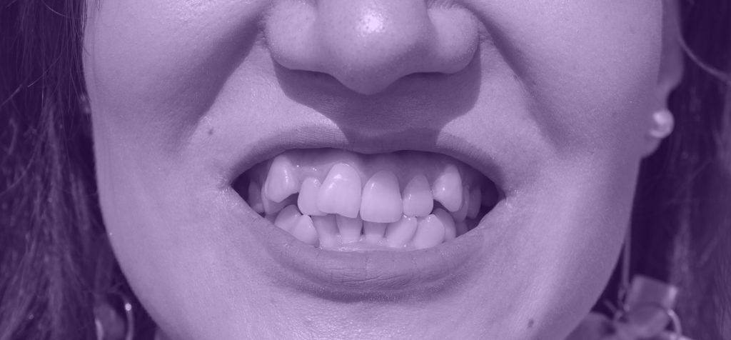dientes-femeninos-curvados-antes-instalar-frenillos-primer-plano-dientes-antes-tratamiento-parte-ortodoncista